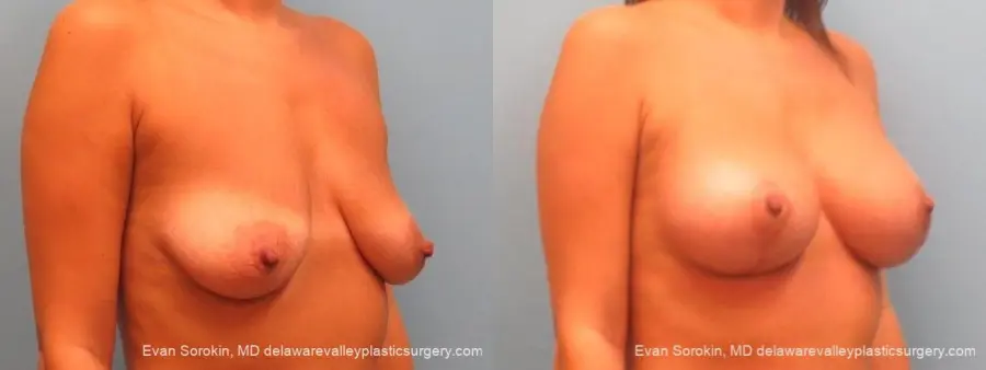 Philadelphia Breast Lift and Augmentation 10247 - Before and After 2