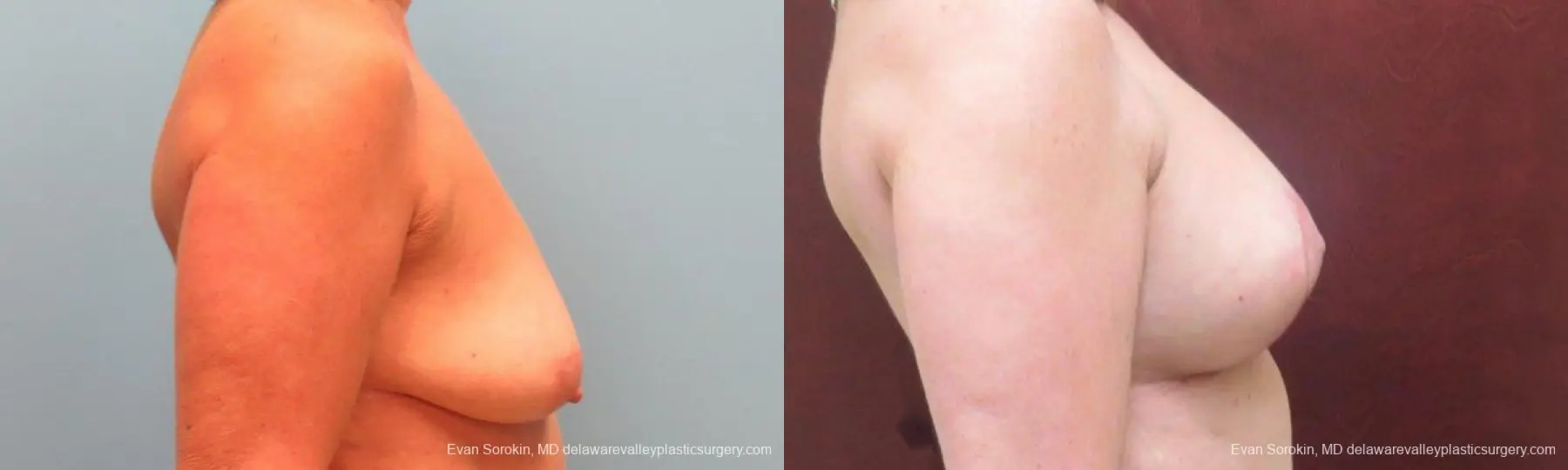 Philadelphia Breast Lift and Augmentation 9598 - Before and After 3