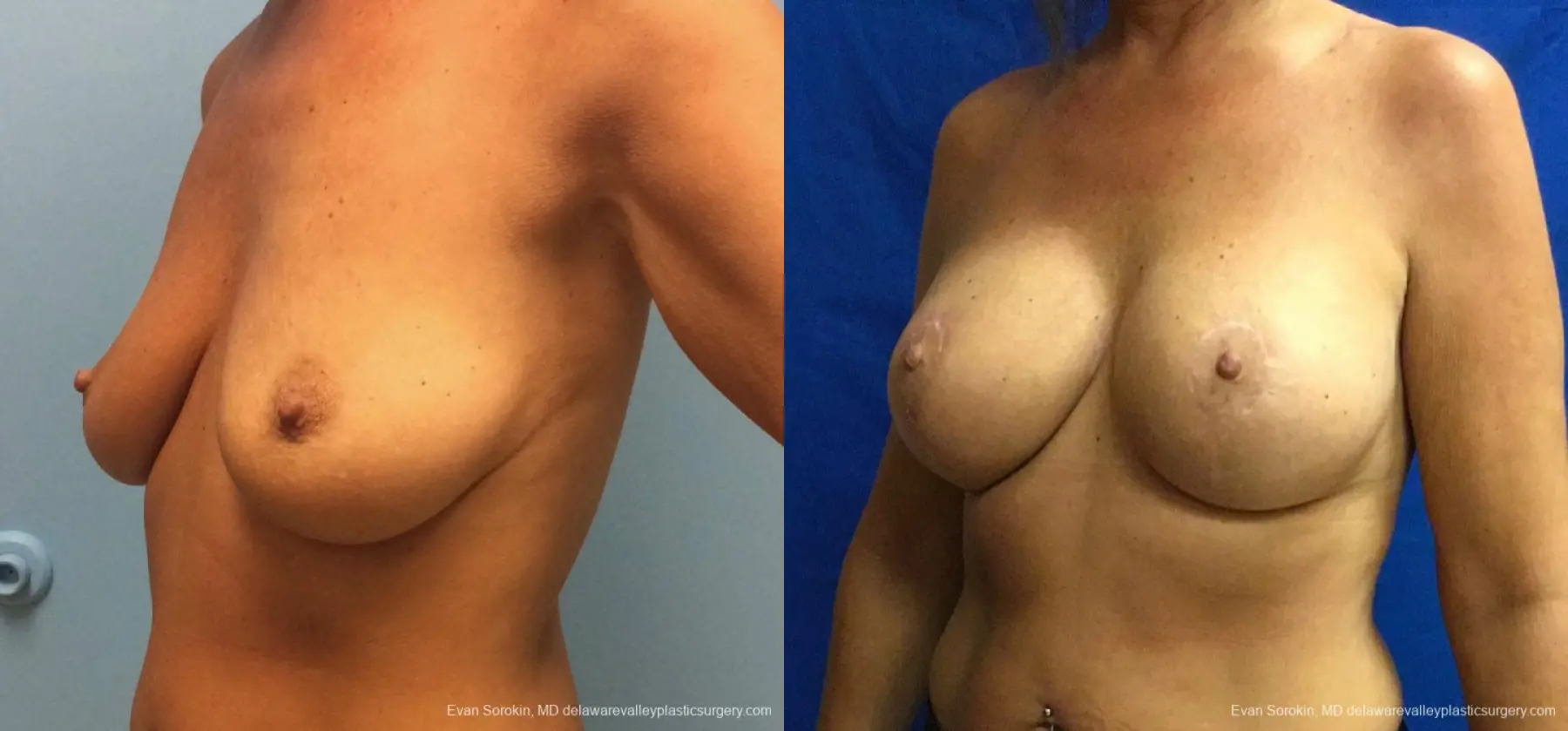 Philadelphia Breast Lift and Augmentation 13068 - Before and After 4
