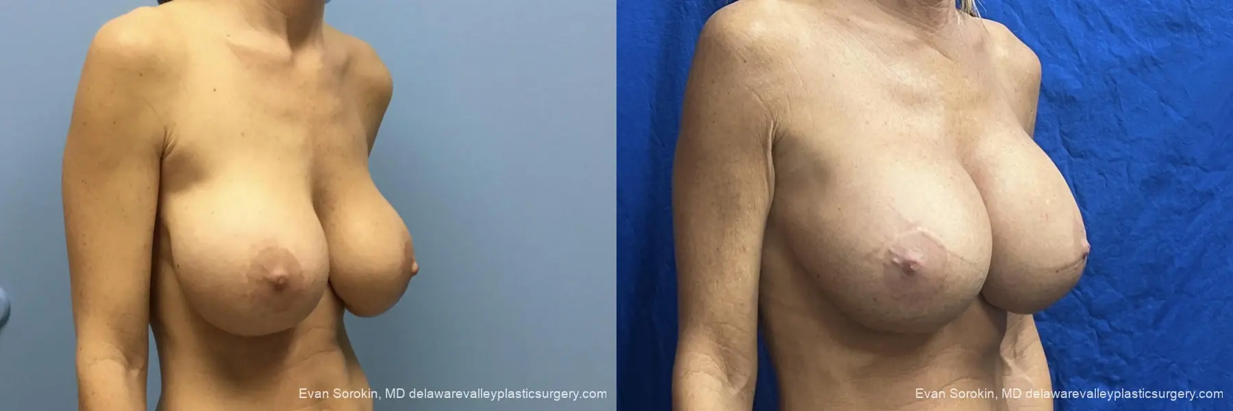 Breast Lift And Augmentation: Patient 58 - Before and After 2