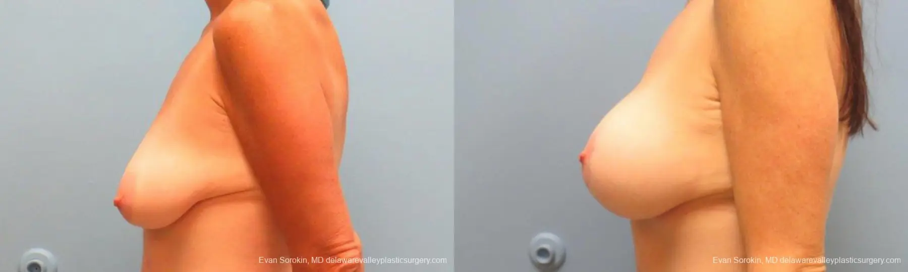 Philadelphia Breast Lift and Augmentation 9486 - Before and After 5