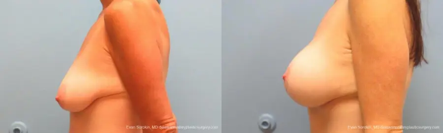 Philadelphia Breast Lift and Augmentation 9486 - Before and After 5