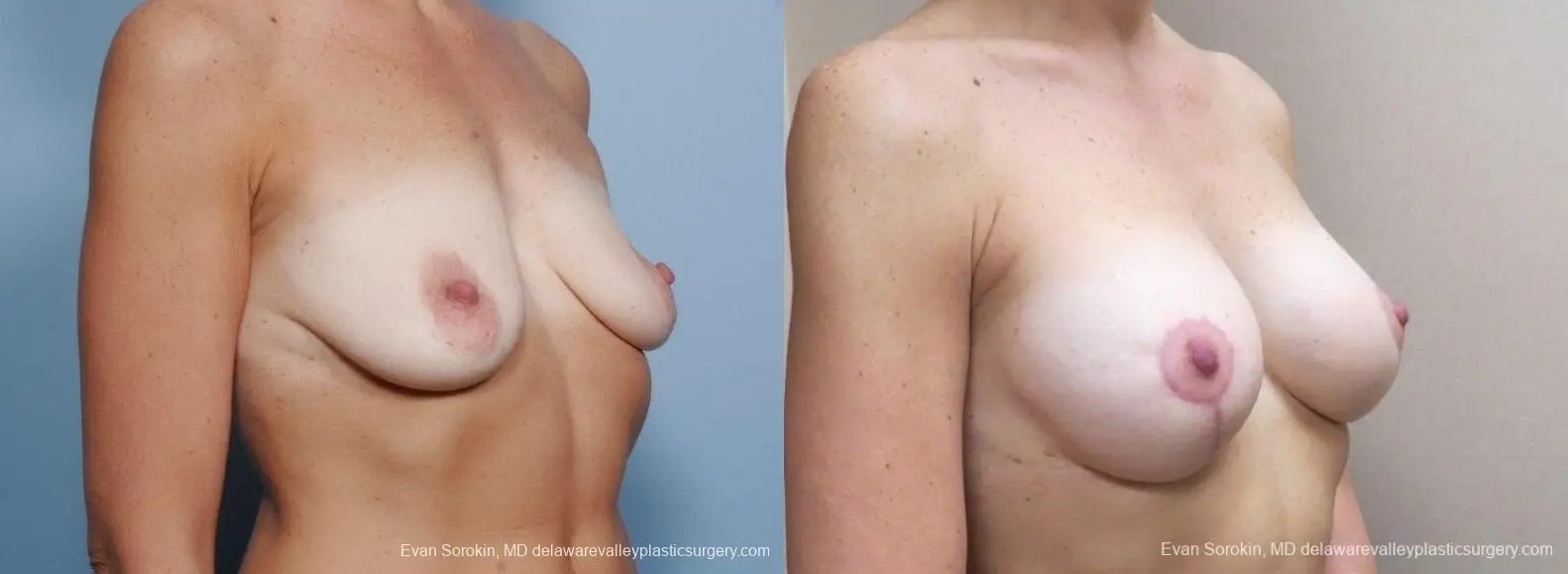 Philadelphia Breast Lift and Augmentation 8683 - Before and After 2