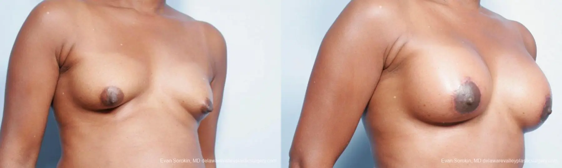Philadelphia Breast Lift and Augmentation 9427 - Before and After 2