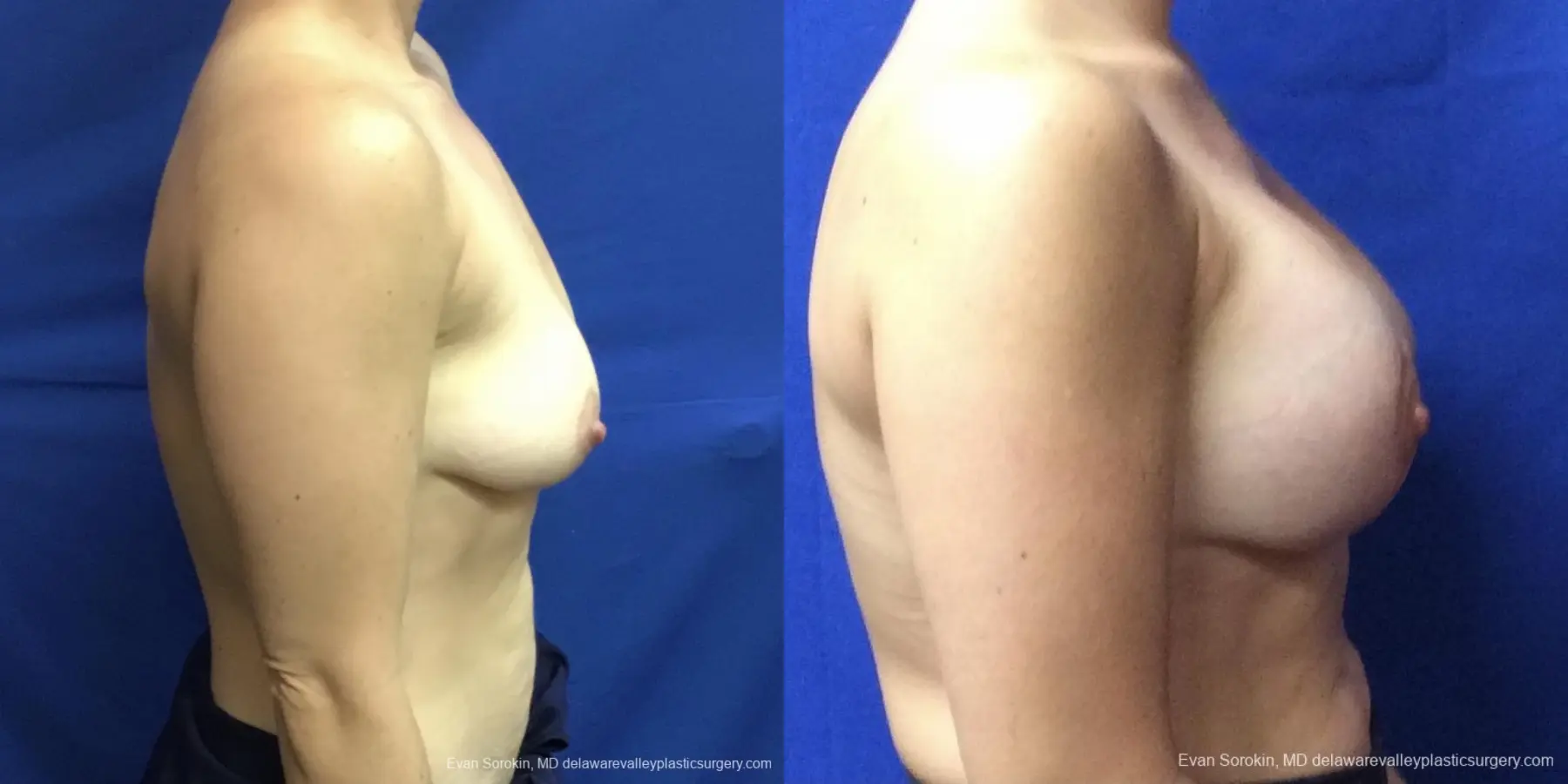 Breast Lift And Augmentation: Patient 3 - Before and After 3