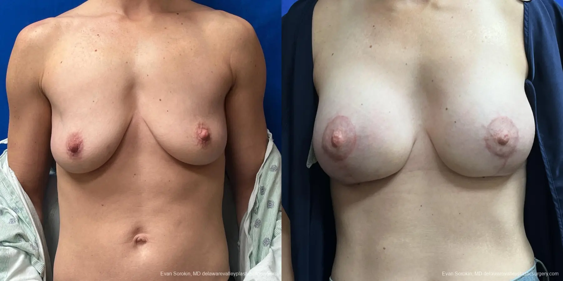 Breast Lift And Augmentation: Patient 46 - Before and After 1