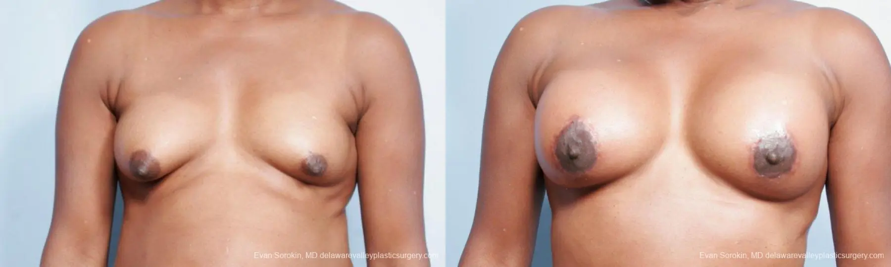 Philadelphia Breast Lift and Augmentation 9427 - Before and After 1