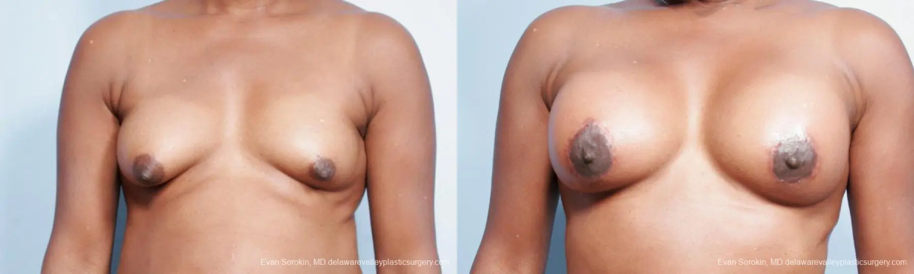 Philadelphia Breast Lift and Augmentation 9427 - Before and After