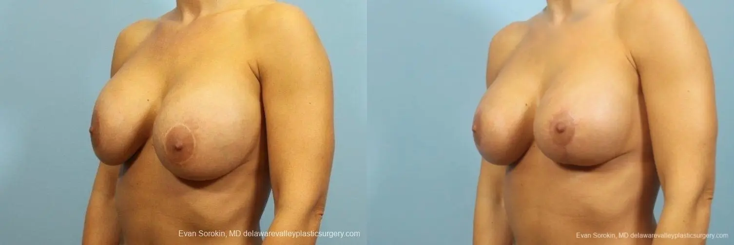 Philadelphia Breast Lift and Augmentation 8710 - Before and After 3