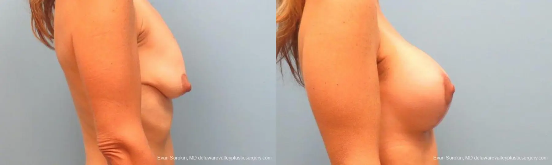 Philadelphia Breast Lift and Augmentation 9485 - Before and After 3