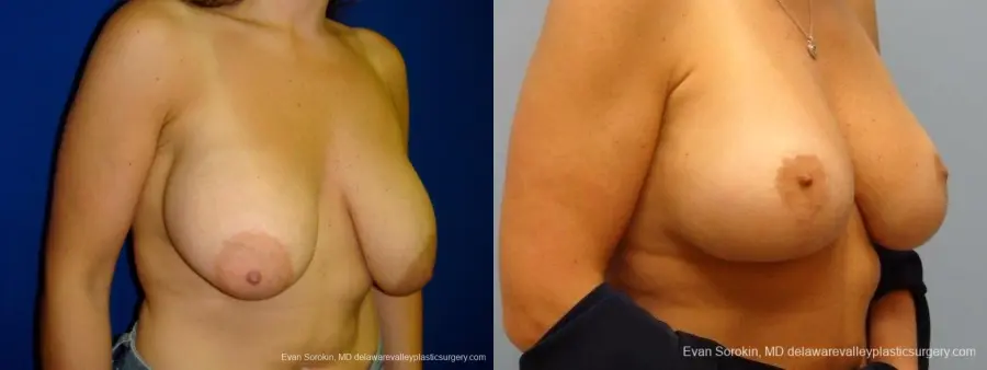 Philadelphia Breast Lift and Augmentation 8696 - Before and After 2