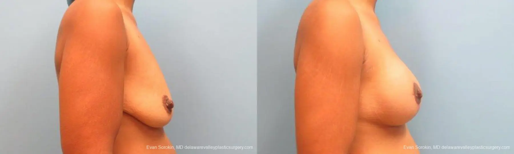 Philadelphia Breast Lift and Augmentation 9343 - Before and After 3