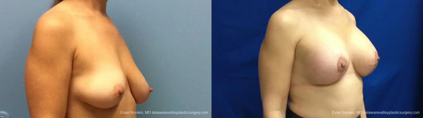 Philadelphia Breast Lift and Augmentation 13179 - Before and After 3