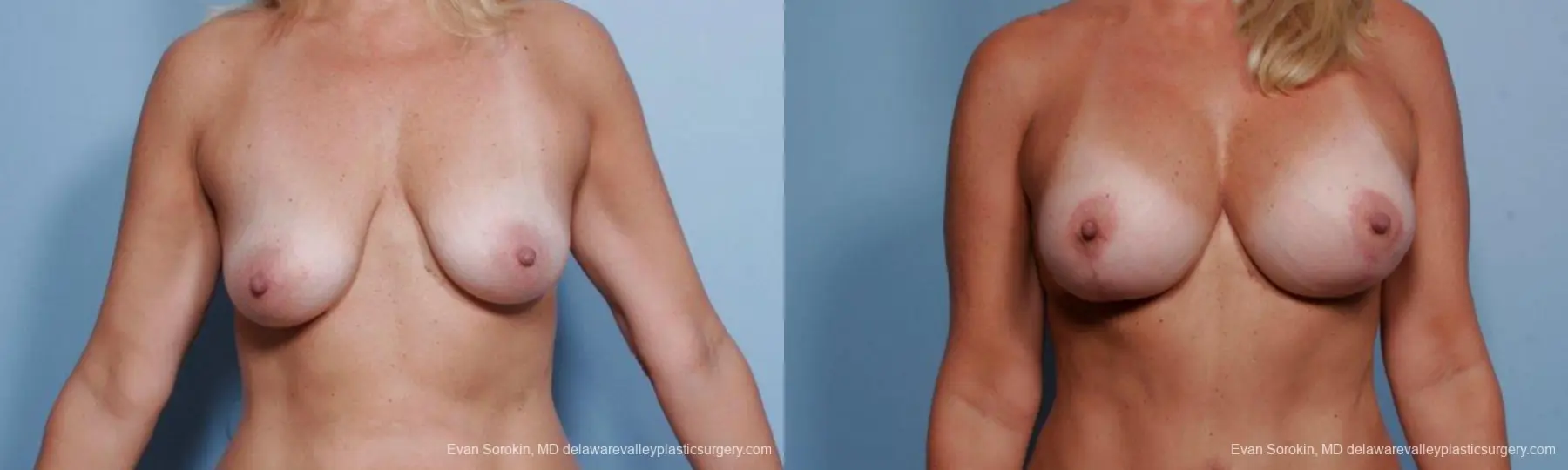 Philadelphia Breast Lift and Augmentation 9375 - Before and After 1