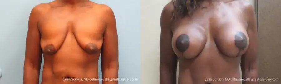 Philadelphia Breast Lift and Augmentation 10120 - Before and After 1