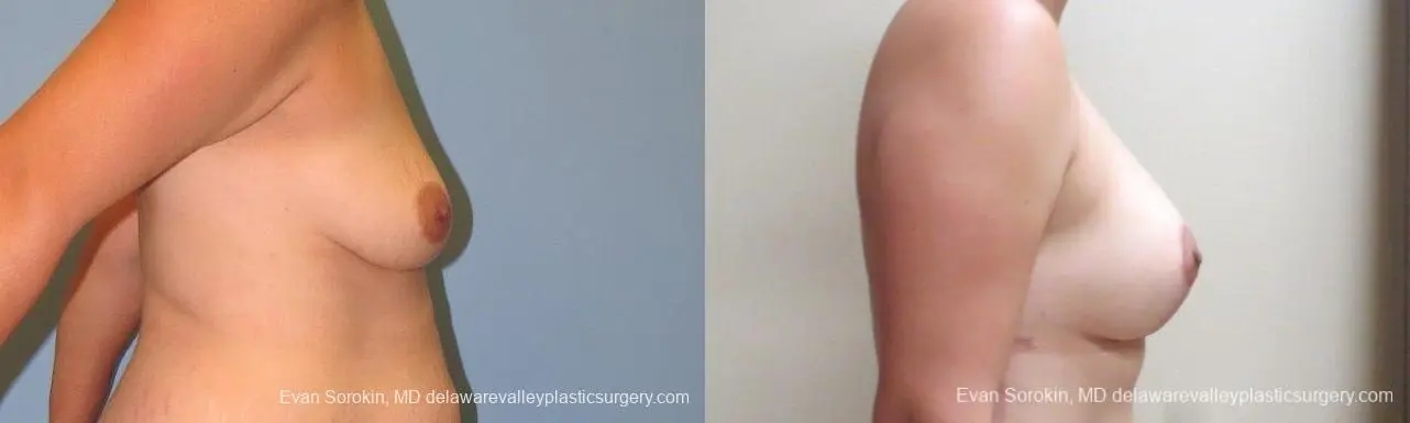 Philadelphia Breast Lift and Augmentation 10123 - Before and After 3