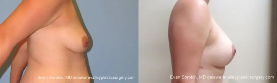 Philadelphia Breast Lift and Augmentation 10123 - Before and After 3