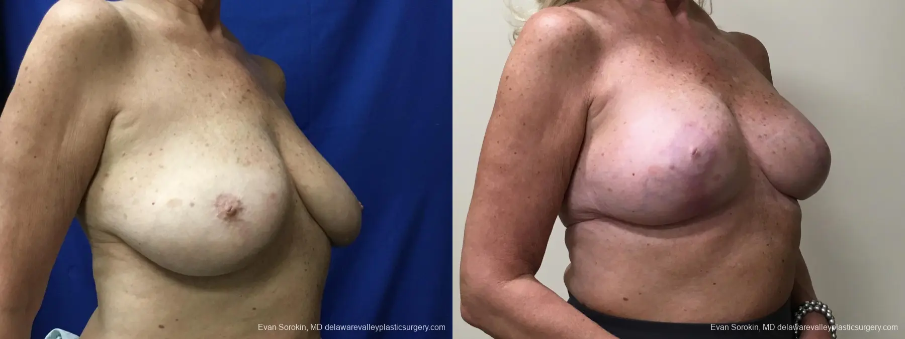 Breast Lift And Augmentation: Patient 49 - Before and After 2