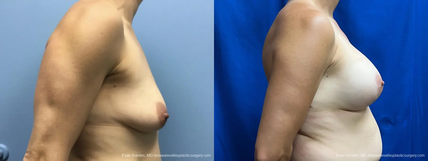 Breast Lift And Augmentation: Patient 48 - Before and After 3