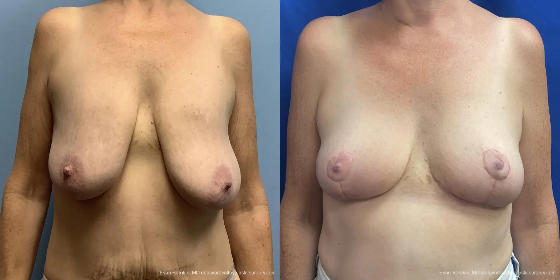 Breast Lift: Patient 2 - Before and After  