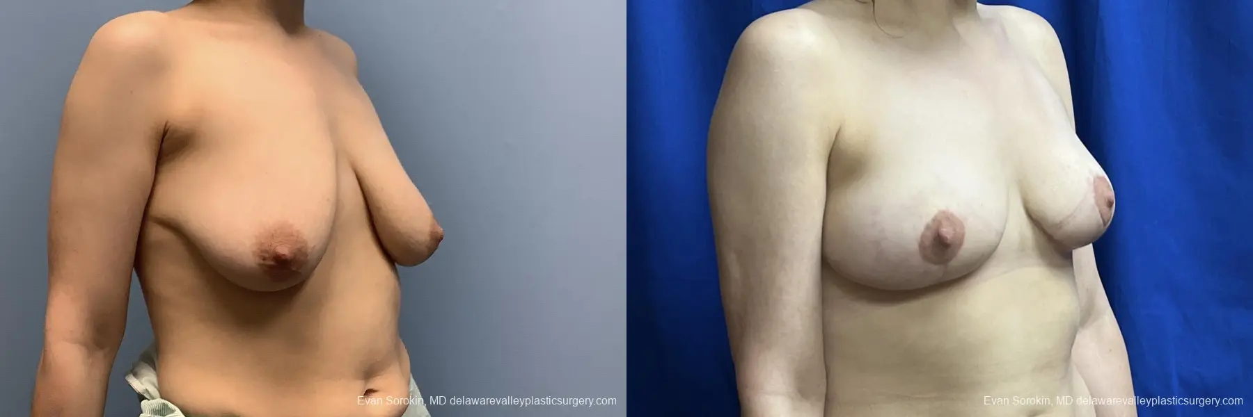 Breast Lift: Patient 4 - Before and After 2