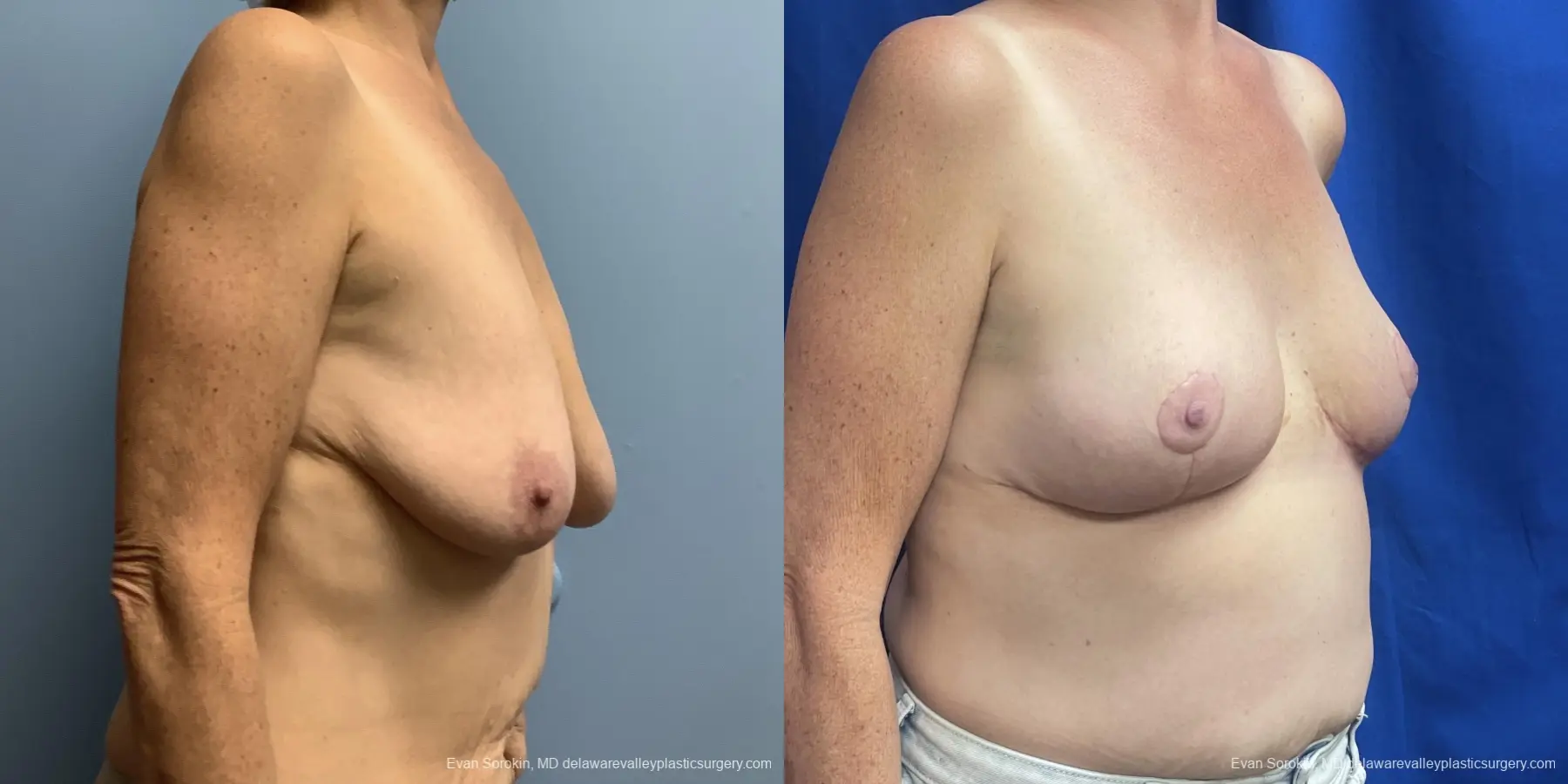 Breast Lift: Patient 3 - Before and After 2