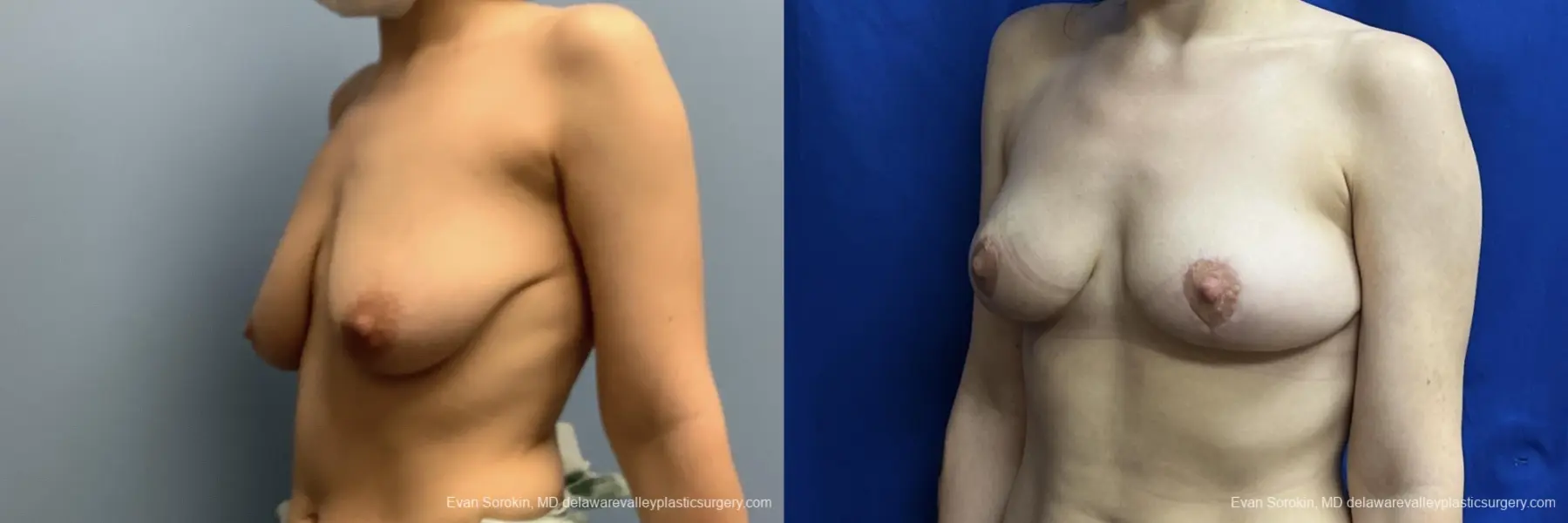 Breast Lift: Patient 4 - Before and After 4