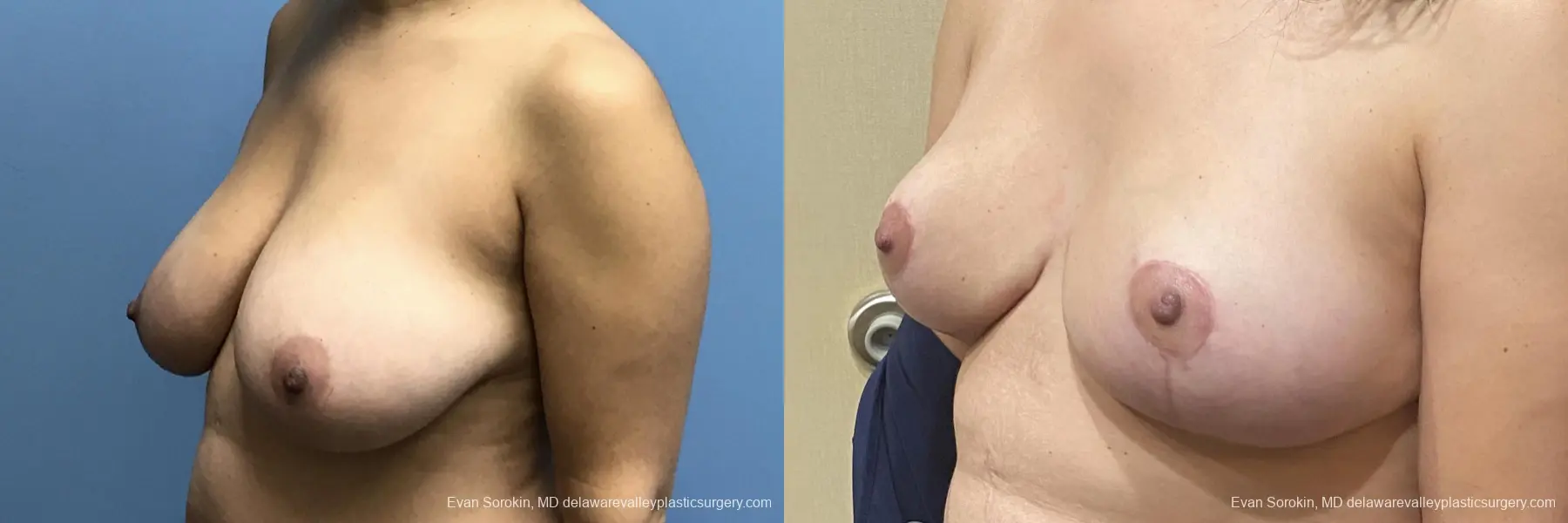 Breast Lift: Patient 1 - Before and After 4