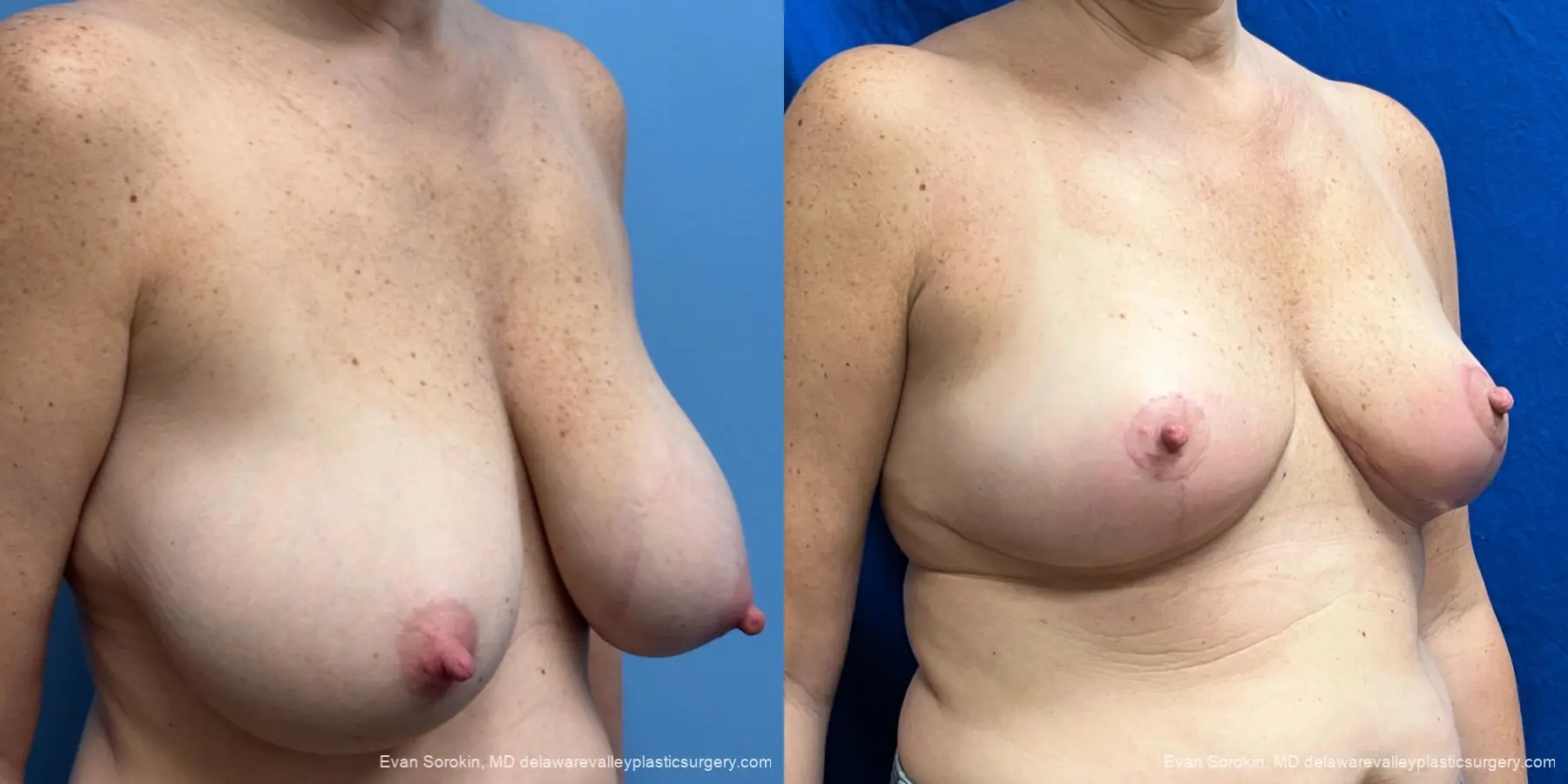 Breast Lift: Patient 3 - Before and After 2