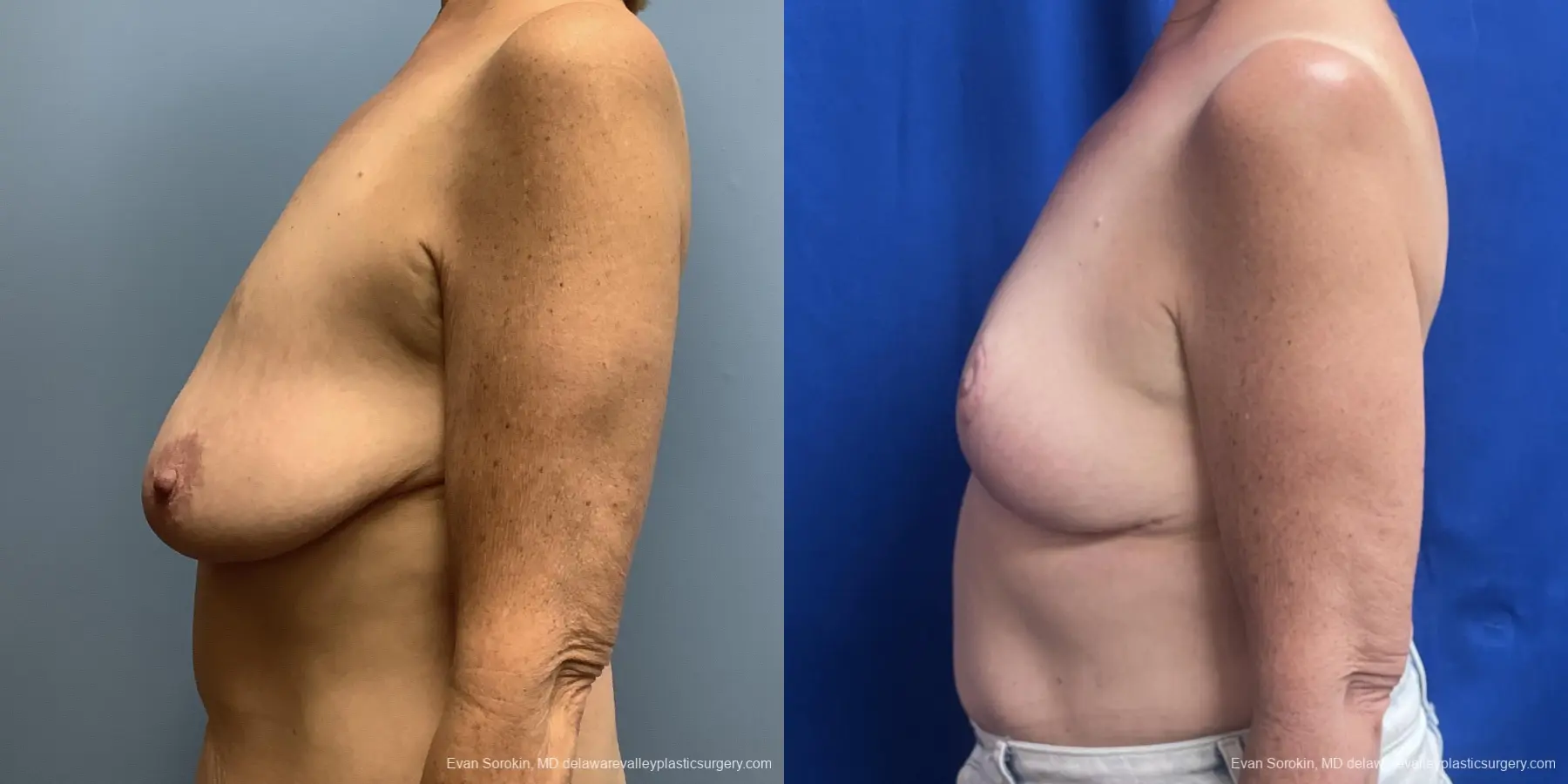 Breast Lift: Patient 2 - Before and After 5