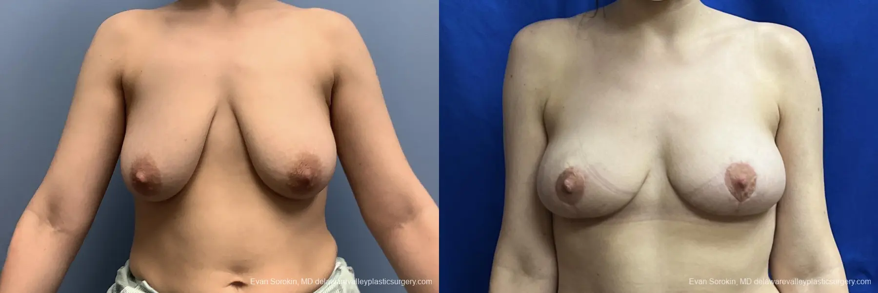 Breast Lift: Patient 3 - Before and After 1