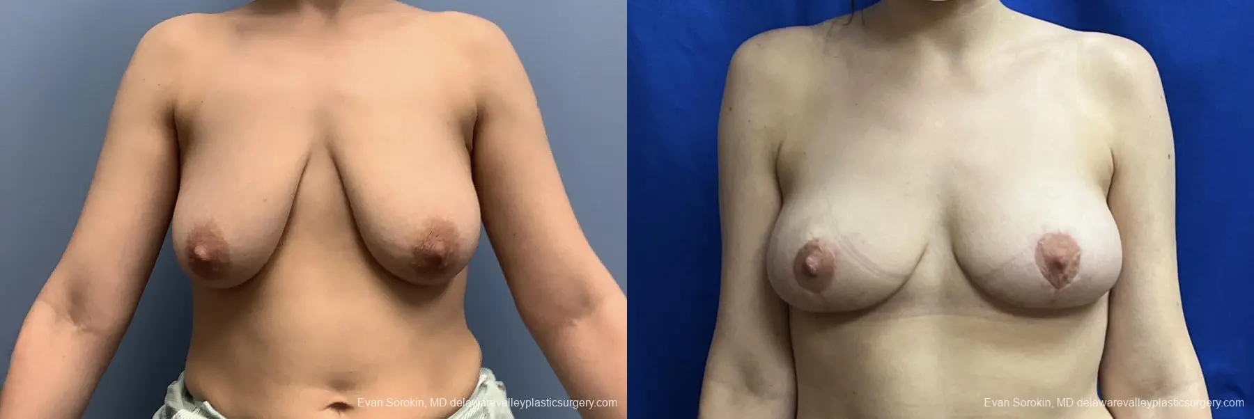 Breast Lift: Patient 4 - Before and After 1