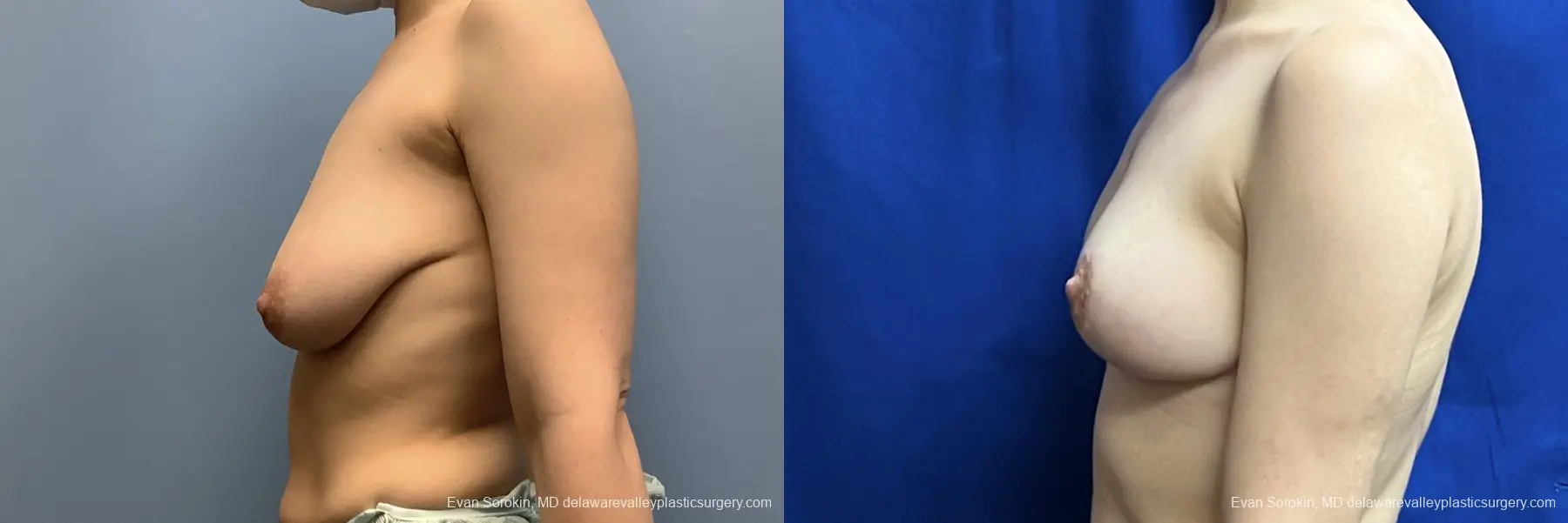Breast Lift: Patient 3 - Before and After 5