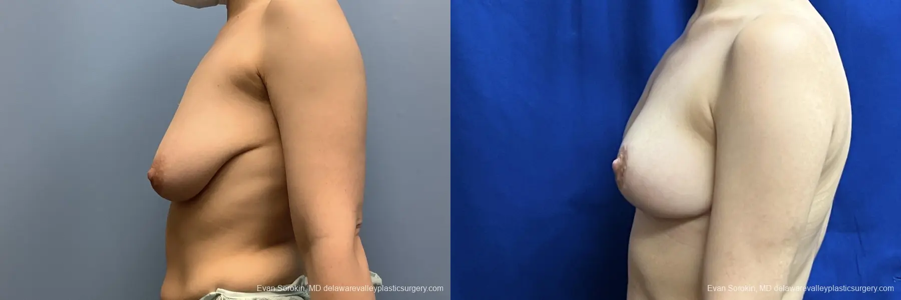 Breast Lift: Patient 4 - Before and After 5