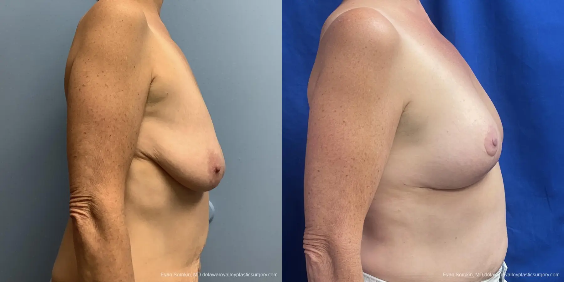 Breast Lift: Patient 2 - Before and After 3