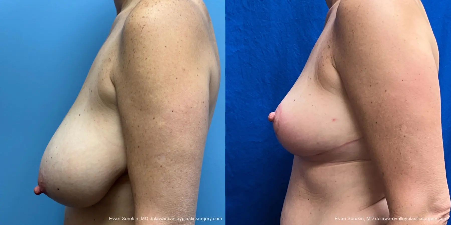 Breast Lift: Patient 3 - Before and After 5