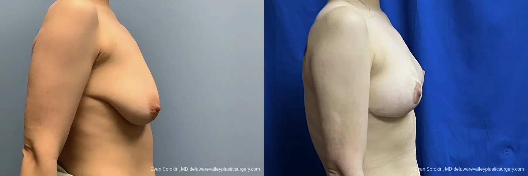 Breast Lift: Patient 3 - Before and After 3