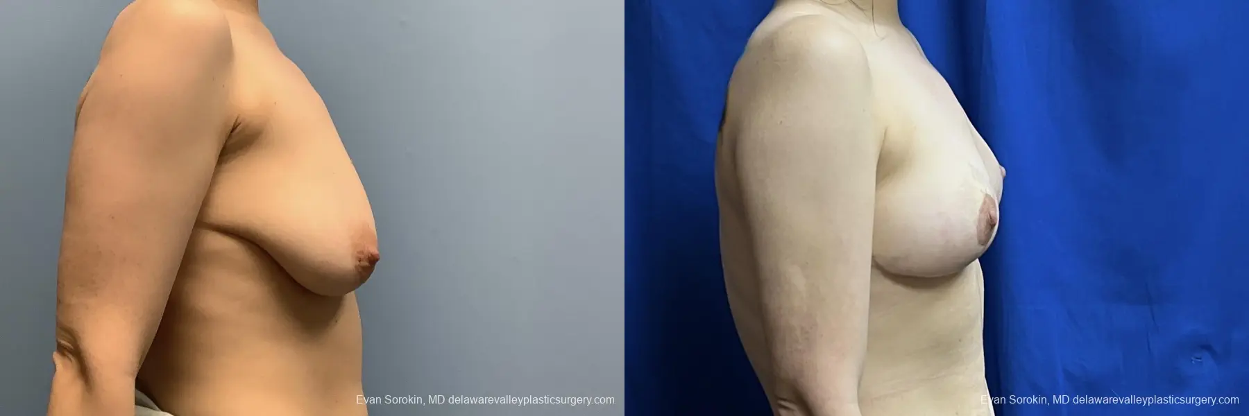 Breast Lift: Patient 4 - Before and After 3