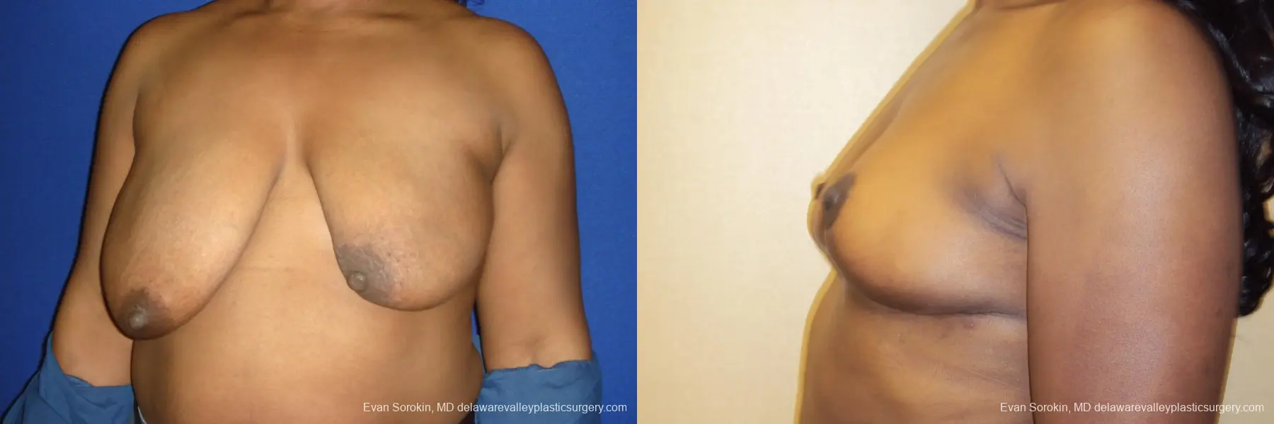 Breast Lift: Patient 5 - Before and After 4