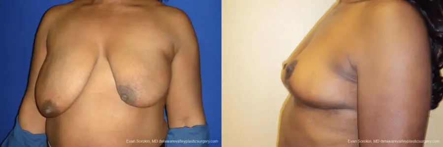 Breast Lift: Patient 2 - Before and After 4