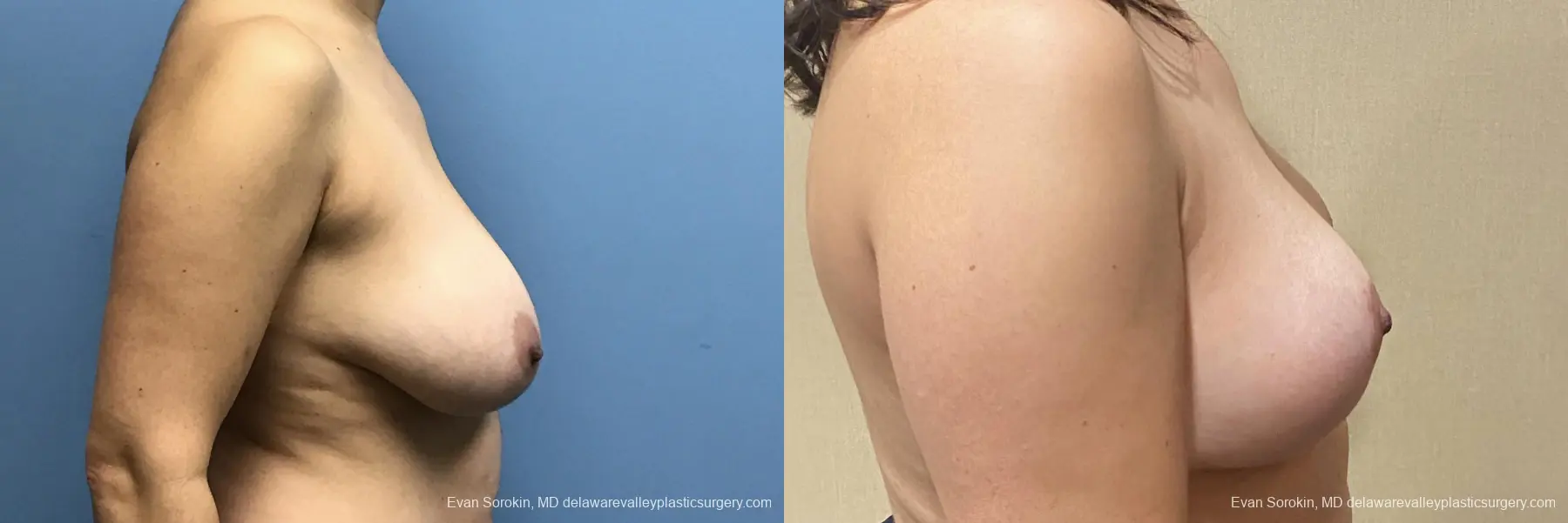 Breast Lift: Patient 1 - Before and After 3