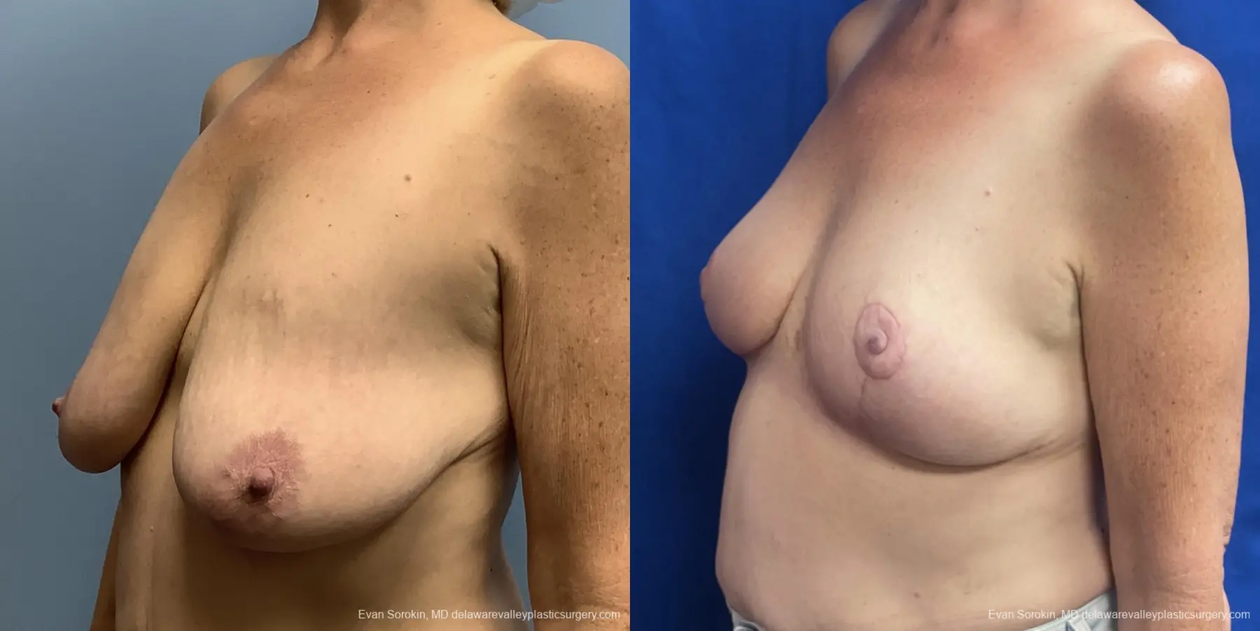 Breast Lift: Patient 1 - Before and After 4