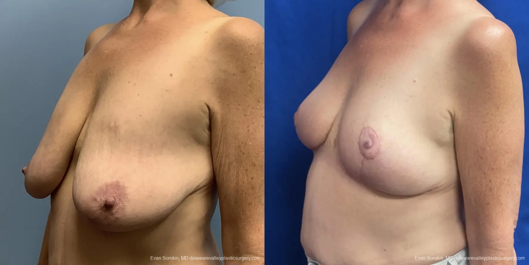 Breast Lift: Patient 2 - Before and After 4