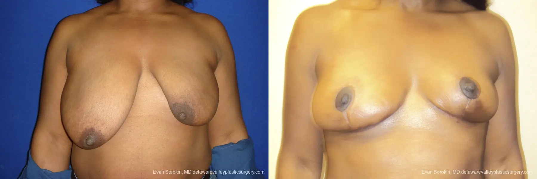 Breast Lift: Patient 2 - Before and After 1