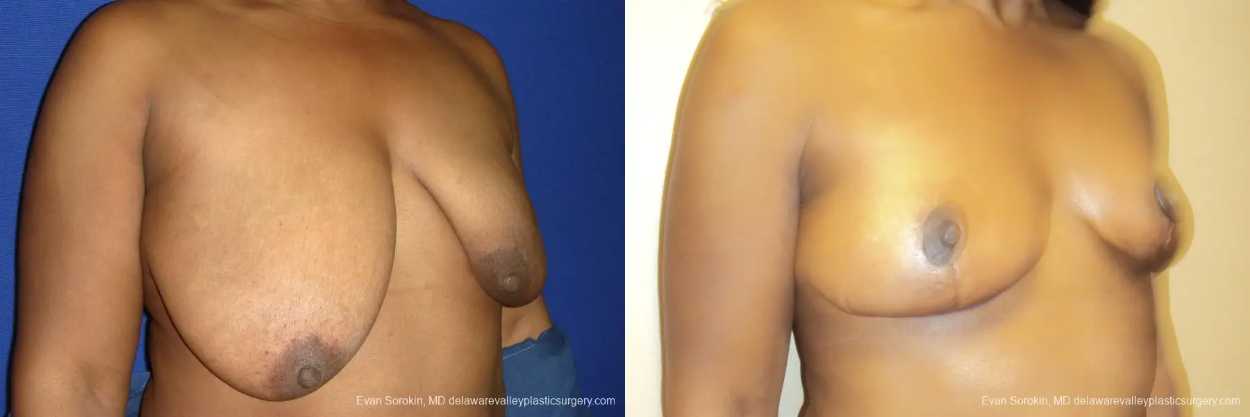 Breast Lift: Patient 3 - Before and After 2