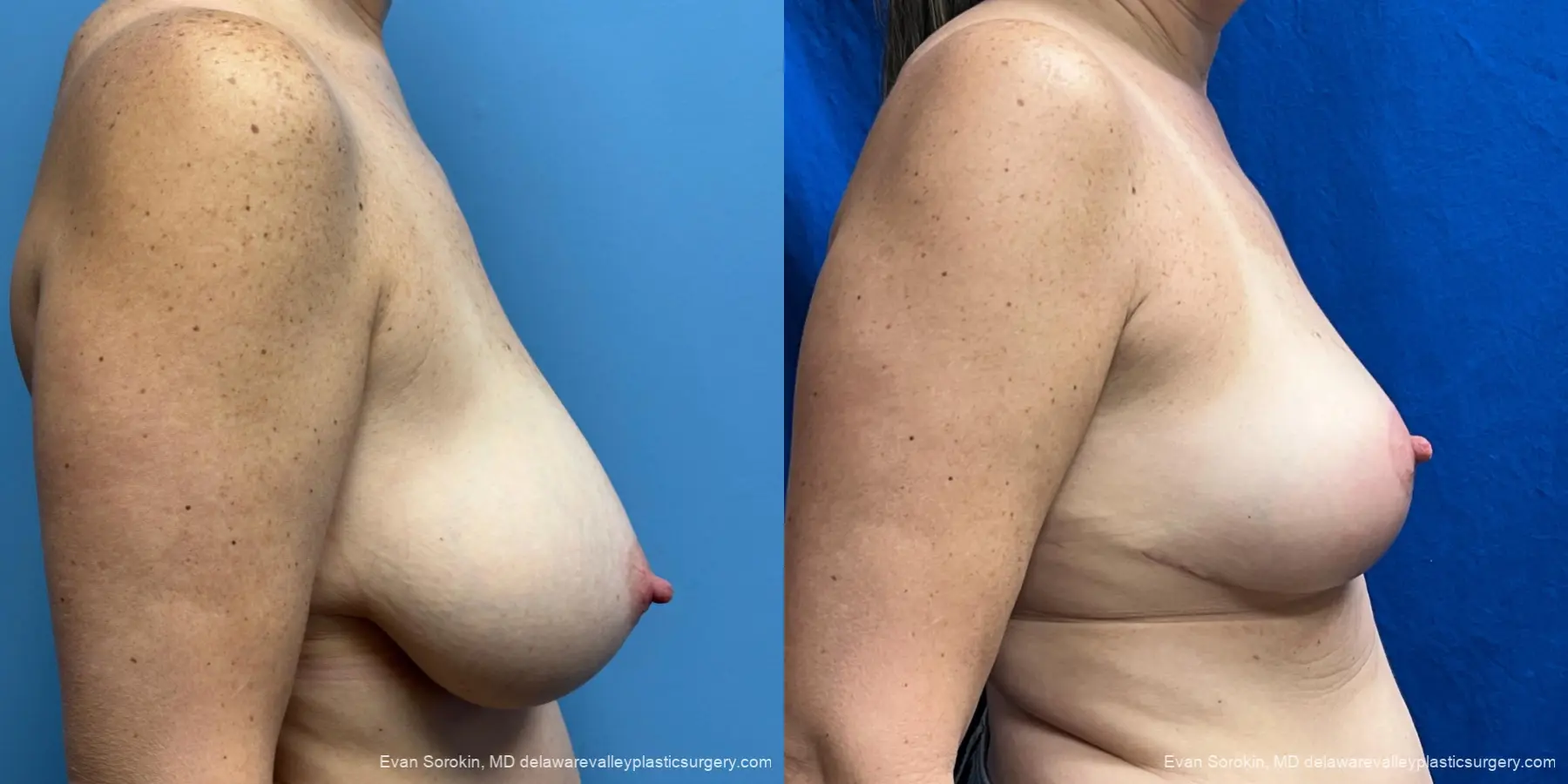 Breast Lift: Patient 3 - Before and After 3