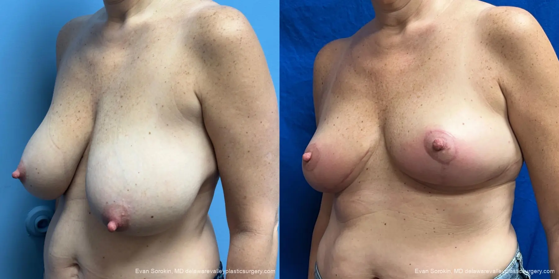 Breast Lift: Patient 3 - Before and After 4