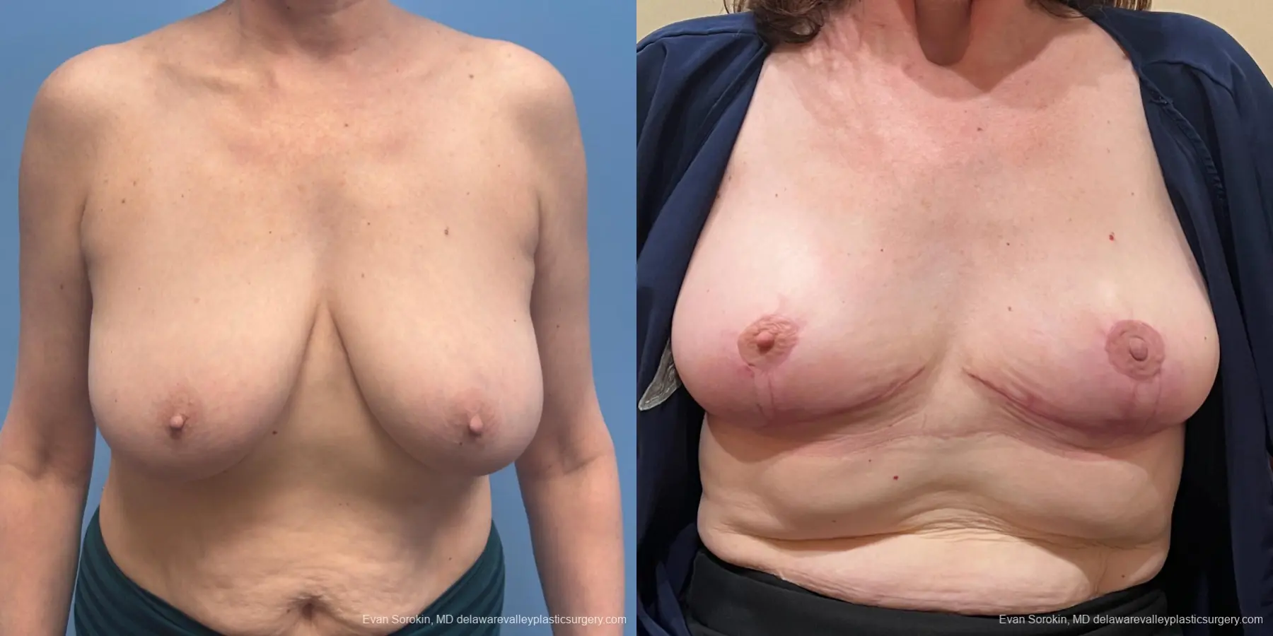 Breast Lift: Patient 4 - Before and After  