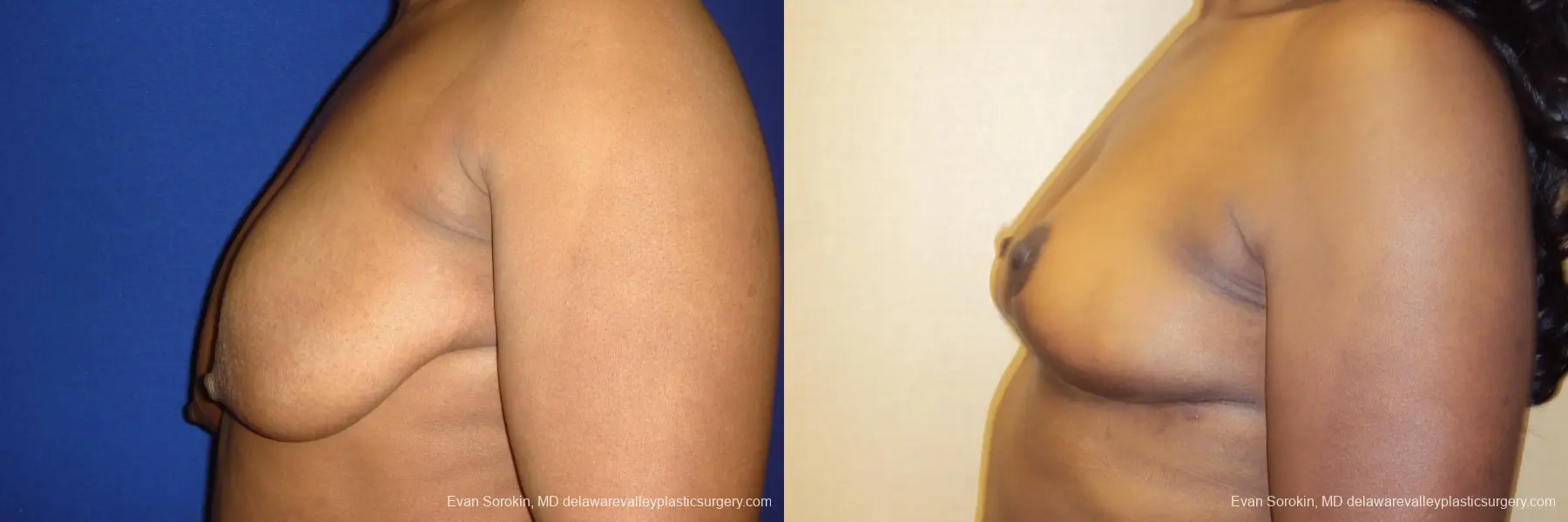 Breast Lift: Patient 5 - Before and After 5