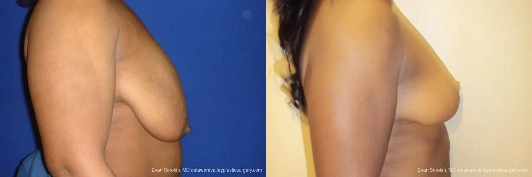 Breast Lift: Patient 5 - Before and After 3